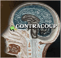 Contracoup