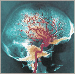 Risk of Subsequent Brain Injury